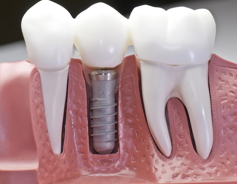 What type of Dental Implant is best for me?