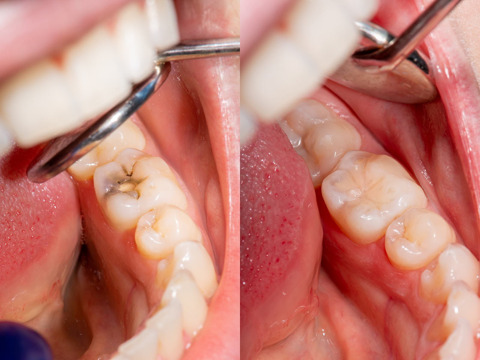 Restoring Smiles with Dental Fillings in Modesto, CA: A Comprehensive Guide